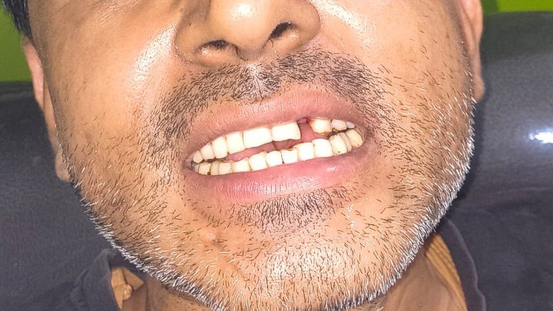 Before dental implant treatment at Bhati Dental Clinic
